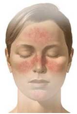 Adult Acne Rosacea